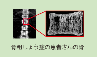 骨粗しょう症の患者さんの骨